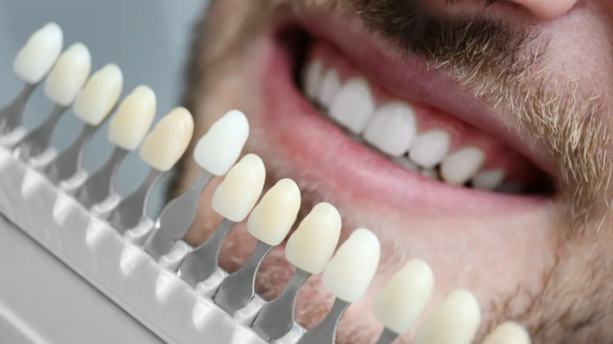O que não pode comer com lente de contato dental